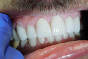Dr. Tartaglione DDS patient results for of an upper and lower Lumineers (Porcelain laminate veneer) case 