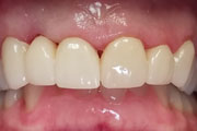 Dr. Tartaglione DDS patient results for poorly aligned upper anterior teeth treated with upper crowns.