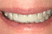 Dr. Tartaglione DDS patient results for old crowns with severe dark roots and margins replaced with new upper crowns.